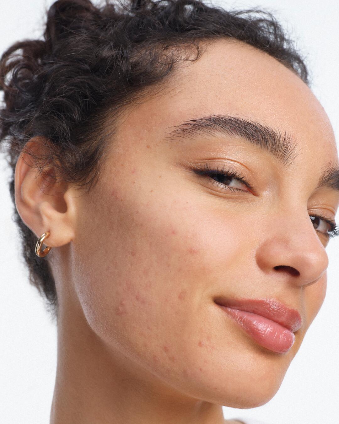 Akneflecken auf den Wangen